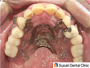 薄くて丈夫な入れ歯