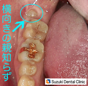 斜めに生えた親知らず