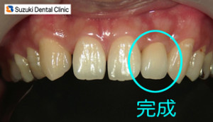 白い歯　オールセラミックス