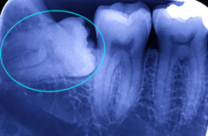 抜歯前のレントゲン