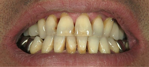 目立たない入れ歯