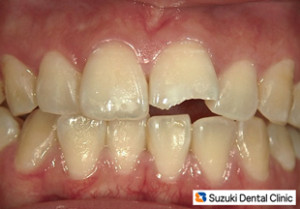 こけて前歯が割れた