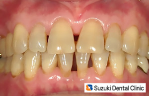 前歯のすき間