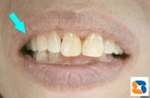 目立たない入れ歯