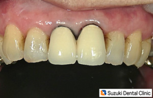 古い前歯の黒いスジ