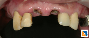 前歯の根が割れる