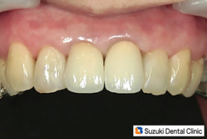 新しくやり直した前歯