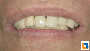 入れ歯の金具は見えません。