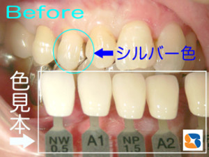 色見本と銀の詰め物