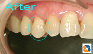 オールセラミックの小さな詰め物