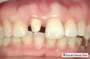 小さくなった歯