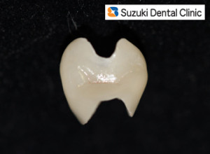 オールセラミックの実物