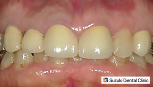セラミックの歯にチェンジ後