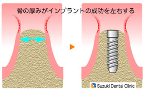 骨を強くしてからインプラントに取り組む