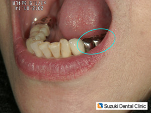 斜め右方向からの口元