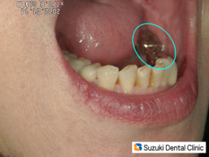 斜め左方向からの口元