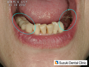 左がセラミック　右が保険の銀歯