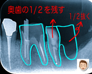 なんとかして奥歯を残す