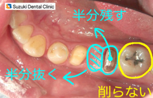 歯を出来るだけ残す取り組み