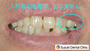 笑っても目立たない保険の入れ歯