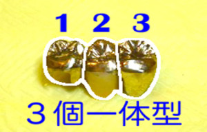 インプラントを避ける治療