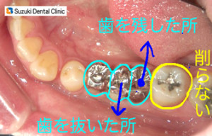 無駄に歯を削らない　インプラントを避ける