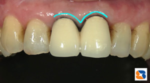 20年前の作り物の前歯