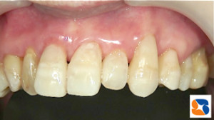 白い詰め物で穴を埋める