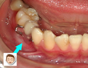 目立たないスッキリしたミニ入れ歯