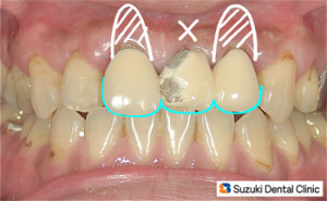 保険の前歯は衝撃に弱い