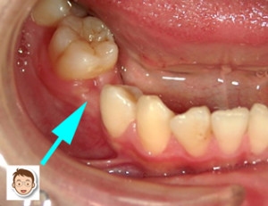生まれつき歯がはえてこない　