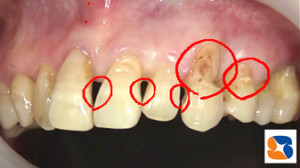 歯と歯の間や際にできた虫歯