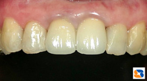 セラミックで前歯を美しく