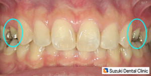 ホワイトニング　と　セラミック