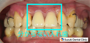入れ歯にみえない入れ歯