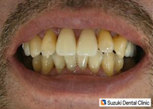 完璧な仕上がりの入れ歯にニッコリ
