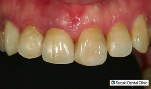 セラミックの前歯
