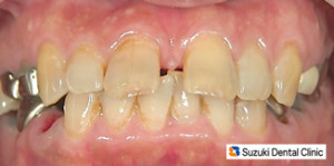 年齢と共に前歯が出る、開く