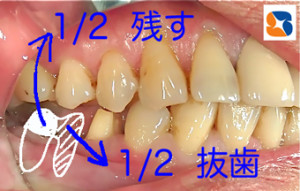 奥歯を半分に割って残す