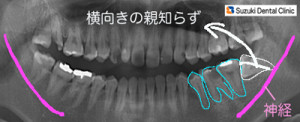 横向き親知らずのレントゲン