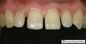 加齢による前歯の開き