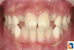 なかなか前歯が生えてきません