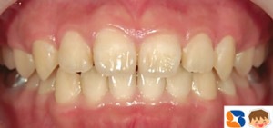 取り外し装置だけで正常に改善