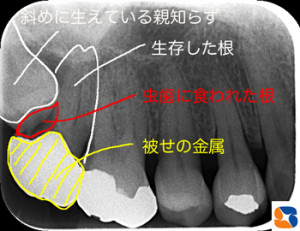 親知らずが斜めに生えている