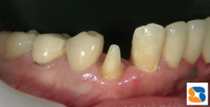 被せを入れる前の状態