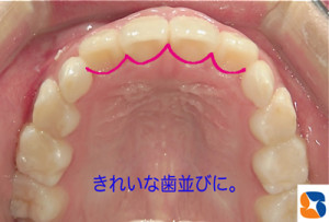 前歯がきれいに揃いました