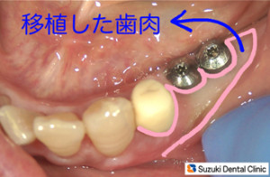 薄い皮から厚い皮へ移植成功