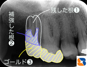 金属で補強された根