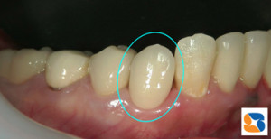 オールセラミック装着