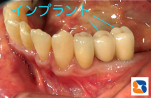 安心、長持ち、確実なインプラント